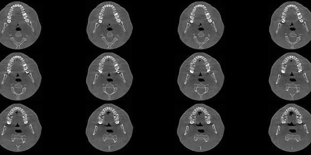 Dental CT