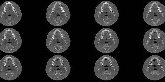 Dental CT