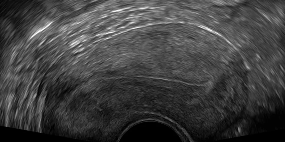 Vaginaler Ultraschall